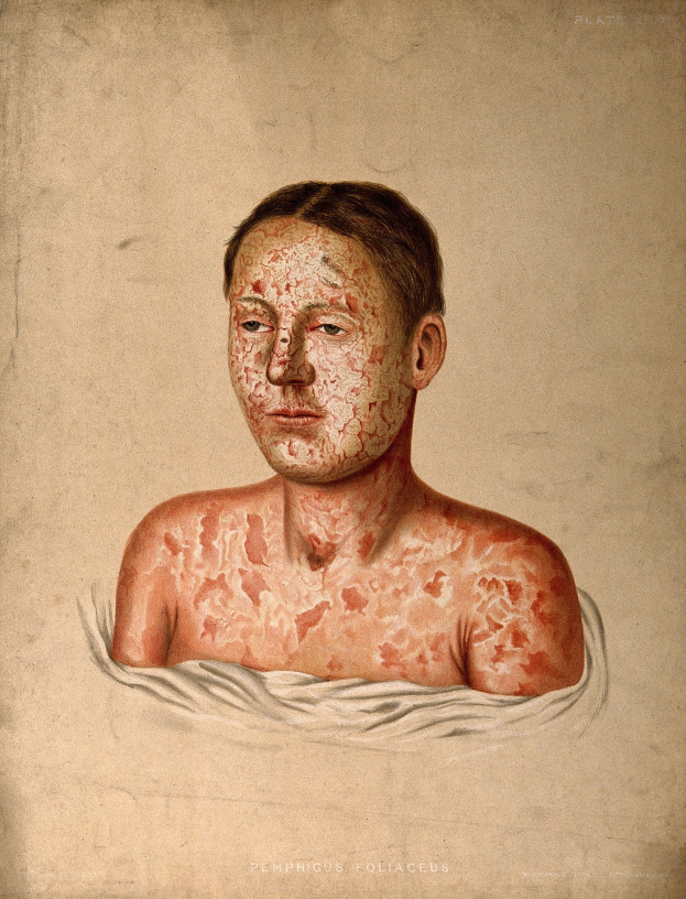Mann mit roten Flecken im Gesicht und auf der Brust, die Hautkrebs darstellen.