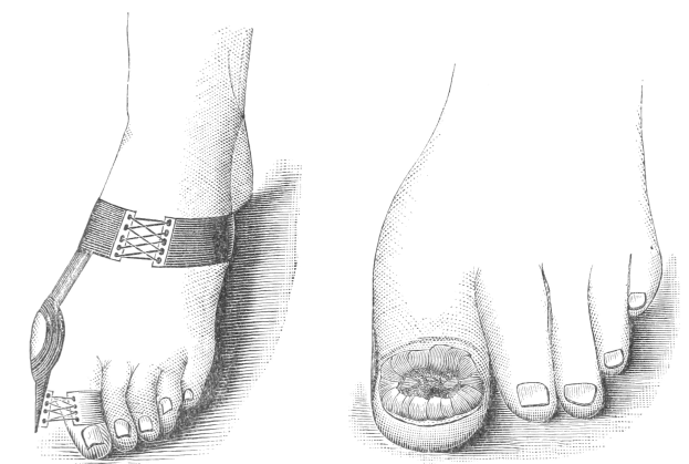 Schwarze und weiße Zeichnung eines Paares Füße, eines mit bandagiertem Bruch und eines mit exponiertem Bruch, mit Text unten, der die medizinische Behandlung angibt.